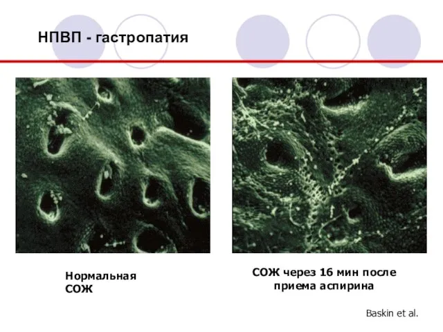 НПВП - гастропатия СОЖ через 16 мин после приема аспирина Baskin et al. Нормальная СОЖ