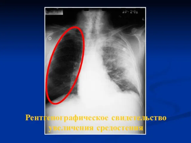 Рентгенографическое свидетельство увеличения средостения