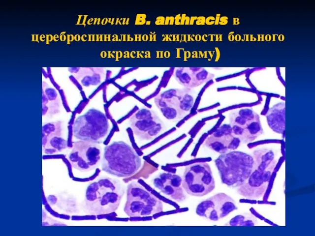 Цепочки B. anthracis в цереброспинальной жидкости больного окраска по Граму)