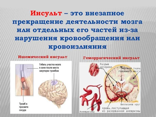 Инсульт – это внезапное прекращение деятельности мозга или отдельных его частей