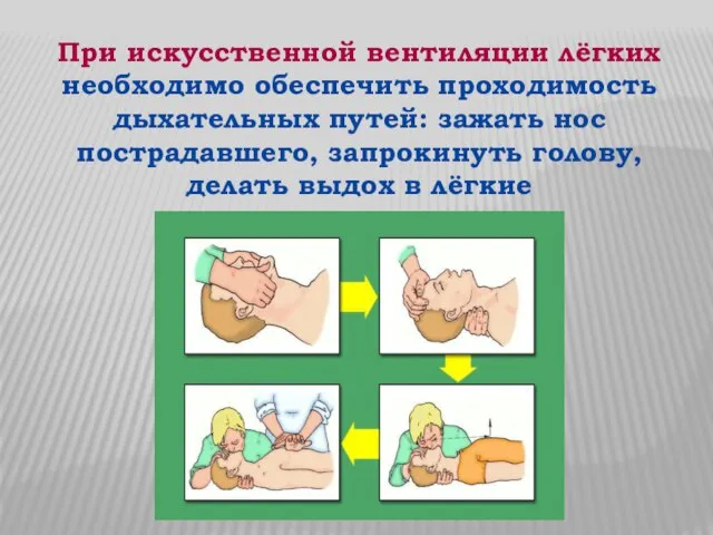 При искусственной вентиляции лёгких необходимо обеспечить проходимость дыхательных путей: зажать нос