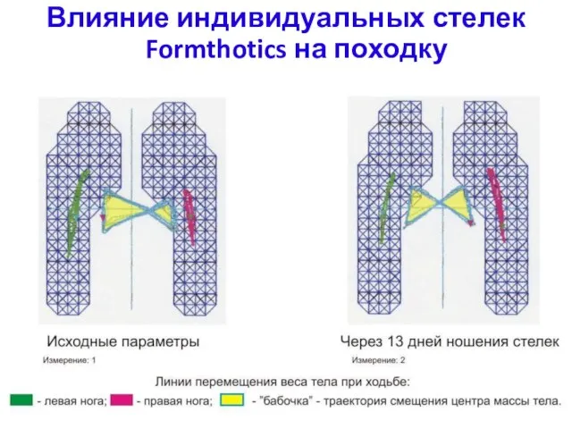 Влияние индивидуальных стелек Formthotics на походку