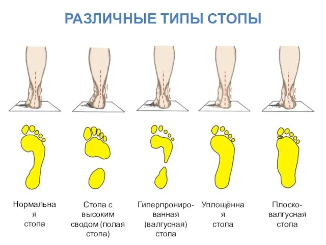 РАЗЛИЧНЫЕ ТИПЫ СТОПЫ Нормальная стопа Стопа с высоким сводом (полая стопа)