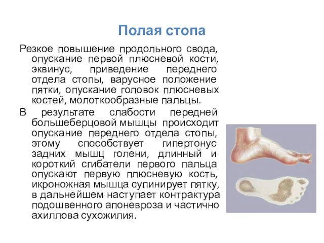 Полая стопа Резкое повышение продольного свода, опускание первой плюсневой кости, эквинус,