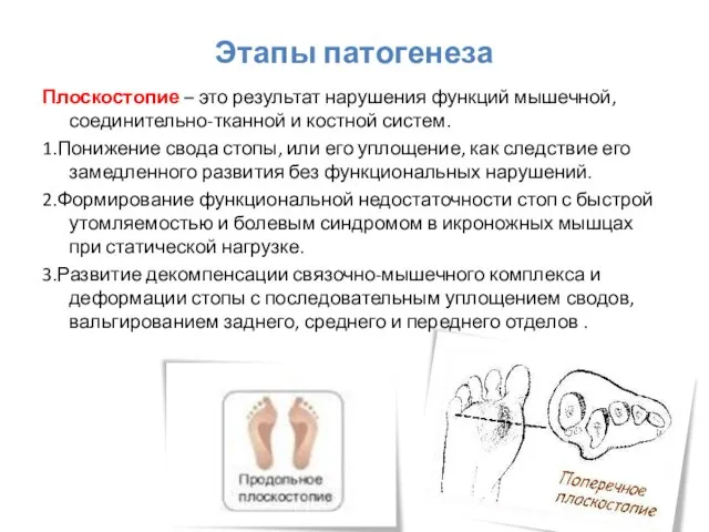 Этапы патогенеза Плоскостопие – это результат нарушения функций мышечной, соединительно-тканной и