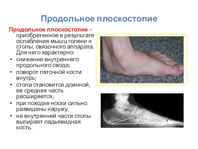 Продольное плоскостопие Продольное плоскостопие – приобретенное в результате ослабления мышц голени