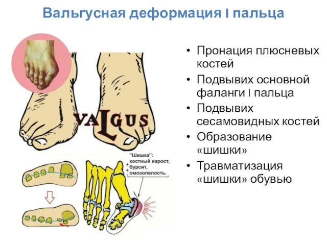 Вальгусная деформация I пальца Пронация плюсневых костей Подвывих основной фаланги I