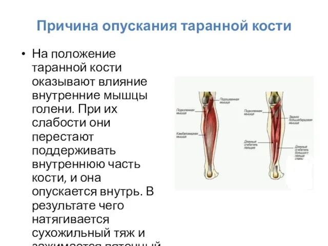 Причина опускания таранной кости На положение таранной кости оказывают влияние внутренние