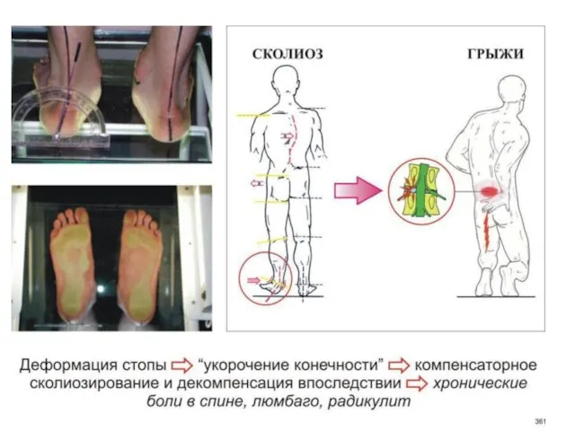 Деформация стопы Относительное укорочение конечности Компенсаторное сколиозирование и декомпенсация Боли в спине, люмбаго, радикулит