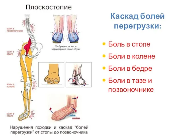 Каскад болей перегрузки: Боль в стопе Боли в колене Боли в