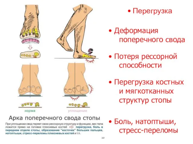 Перегрузка Деформация поперечного свода Потеря рессорной способности Перегрузка костных и мягкотканных структур стопы Боль, натоптыши, стресс-переломы