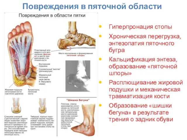 Повреждения в пяточной области Гиперпронация стопы Хроническая перегрузка, энтезопатия пяточного бугра