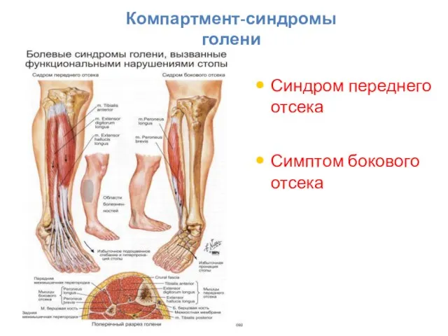 Компартмент-синдромы голени Синдром переднего отсека Симптом бокового отсека