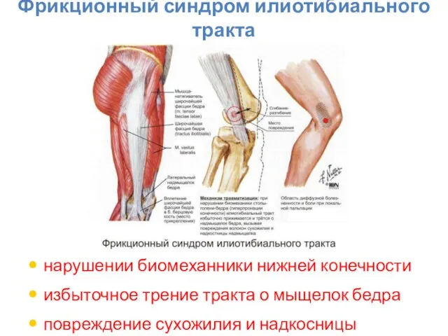 Фрикционный синдром илиотибиального тракта нарушении биомеханники нижней конечности избыточное трение тракта