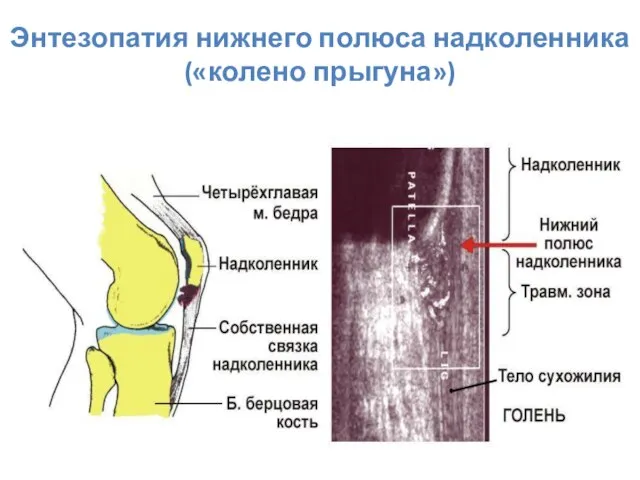 Энтезопатия нижнего полюса надколенника («колено прыгуна»)