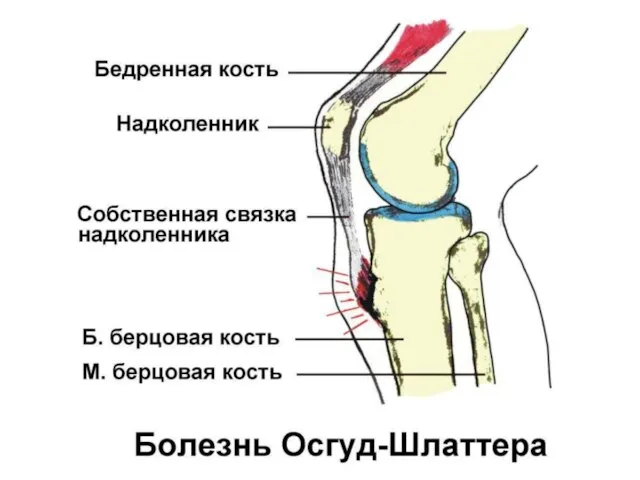 Болезнь Осгуд-Шлаттера