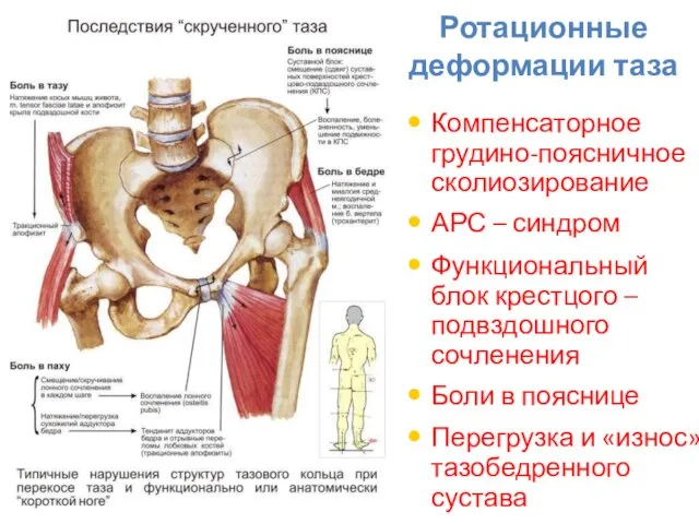 Ротационные деформации таза Компенсаторное грудино-поясничное сколиозирование АРС – синдром Функциональный блок