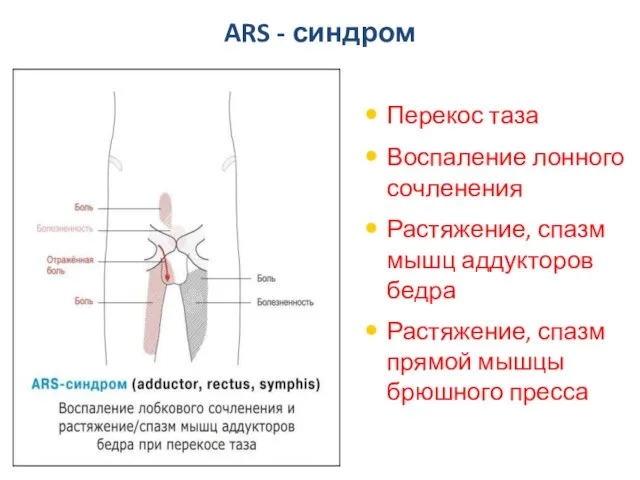 ARS - синдром Перекос таза Воспаление лонного сочленения Растяжение, спазм мышц