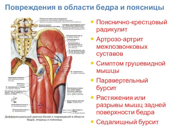 Повреждения в области бедра и поясницы Пояснично-крестцовый радикулит Артрозо-артрит межпозвонковых суставов