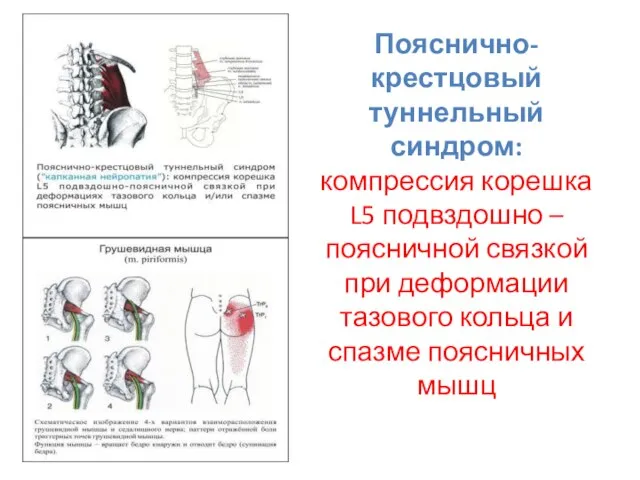 Пояснично-крестцовый туннельный синдром: компрессия корешка L5 подвздошно – поясничной связкой при