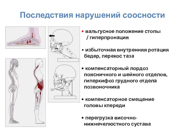 Последствия нарушений соосности вальгусное положение стопы / гиперпронация избыточная внутренняя ротация