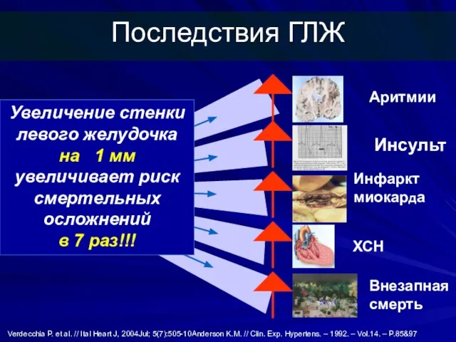 Внезапная смерть Инсульт ХСН Увеличение стенки левого желудочка на 1 мм