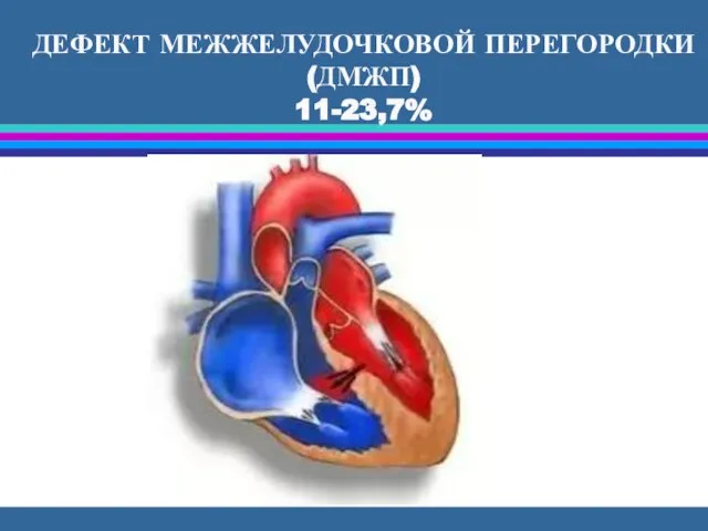 ДЕФЕКТ МЕЖЖЕЛУДОЧКОВОЙ ПЕРЕГОРОДКИ (ДМЖП) 11-23,7%