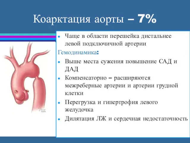 Коарктация аорты – 7% Чаще в области перешейка дистальнее левой подключичной