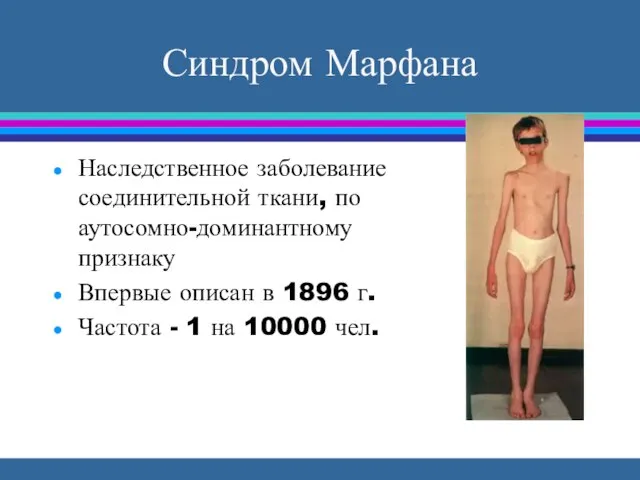 Синдром Марфана Наследственное заболевание соединительной ткани, по аутосомно-доминантному признаку Впервые описан