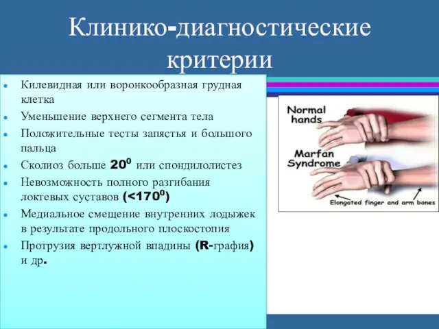 Клинико-диагностические критерии Килевидная или воронкообразная грудная клетка Уменьшение верхнего сегмента тела