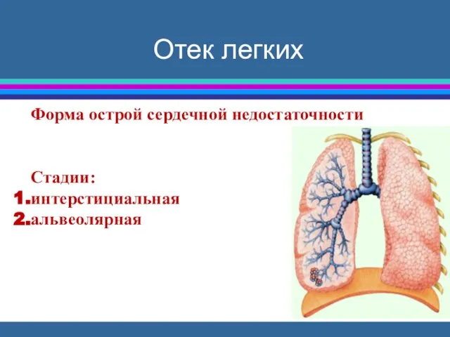 Отек легких Форма острой сердечной недостаточности Стадии: интерстициальная альвеолярная