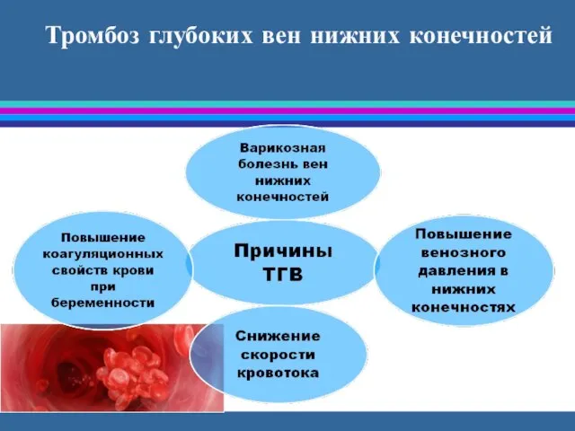 Тромбоз глубоких вен нижних конечностей