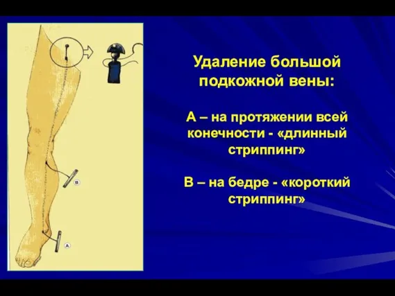 Удаление большой подкожной вены: А – на протяжении всей конечности -