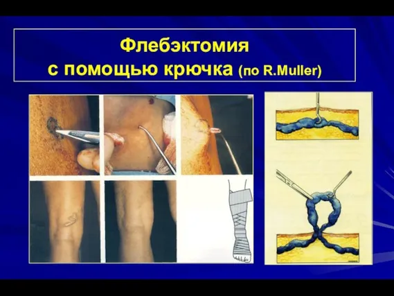 Флебэктомия с помощью крючка (по R.Muller)