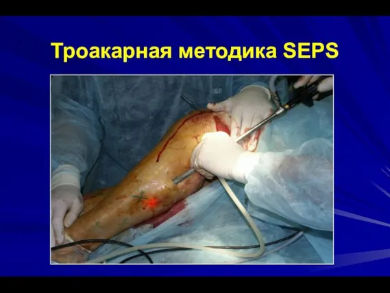 Троакарная методика SEPS