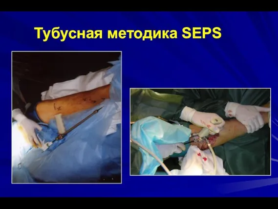 Тубусная методика SEPS