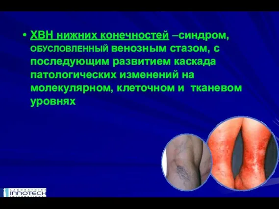 ХВН нижних конечностей –синдром, ОБУСЛОВЛЕННЫЙ венозным стазом, с последующим развитием каскада