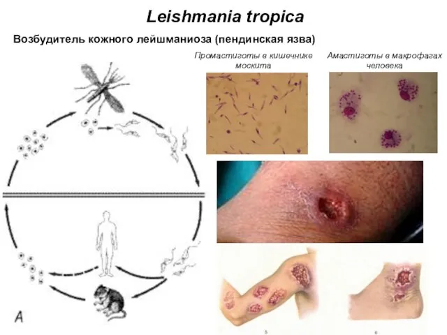 Leishmania tropica Амастиготы в макрофагах человека Промастиготы в кишечнике москита Возбудитель кожного лейшманиоза (пендинская язва)