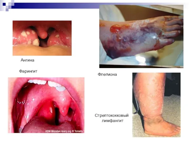 Фарингит Ангина Флегмона Стрептококковый лимфангит