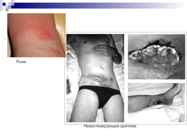 Некротизирующая эритема Рожа