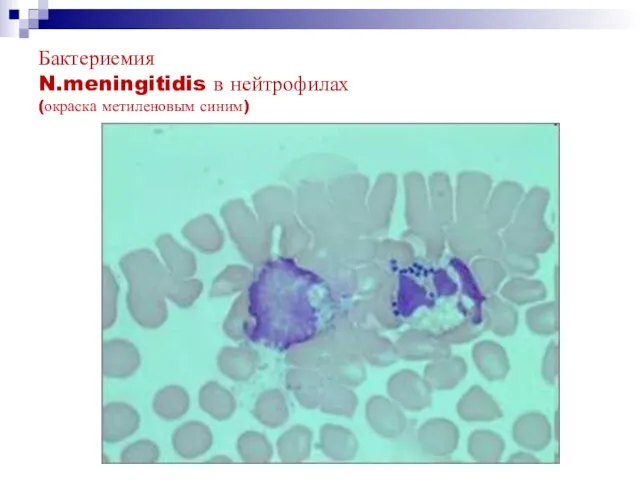 Бактериемия N.meningitidis в нейтрофилах (окраска метиленовым синим)