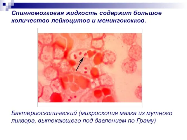 Спинномозговая жидкость содержит большое количество лейкоцитов и менингококков. Бактериоскопический (микроскопия мазка
