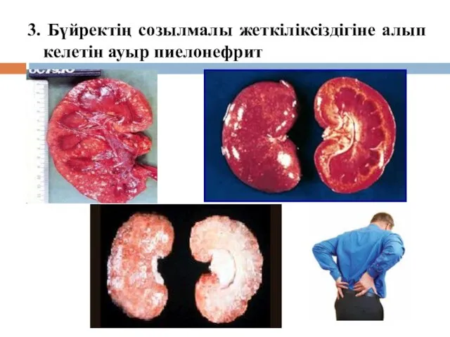 3. Бүйректің созылмалы жеткіліксіздігіне алып келетін ауыр пиелонефрит