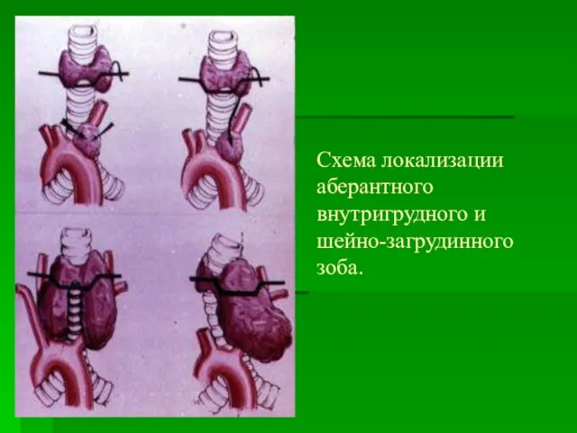 Схема локализации аберантного внутригрудного и шейно-загрудинного зоба.