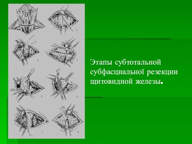 Этапы субтотальной субфасциальної резекции щитовидной железы.