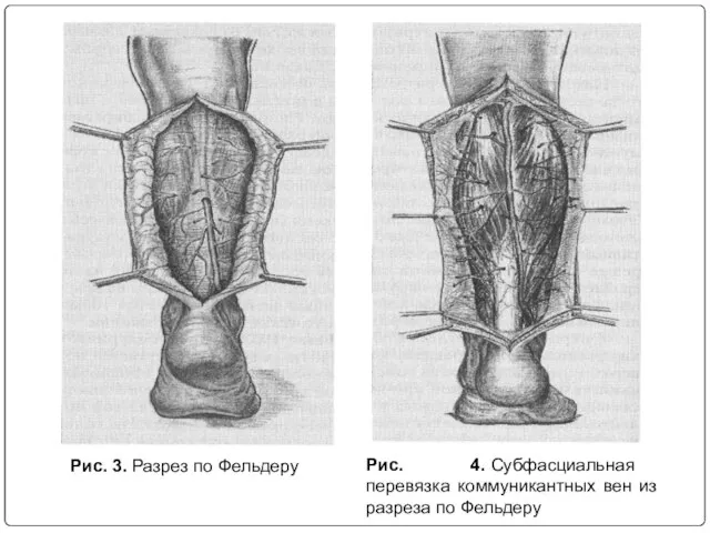 Рис. 3. Разрез по Фельдеру Рис. 4. Субфасциальная перевязка коммуникантных вен из разреза по Фельдеру
