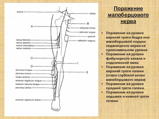 Поражение малоберцового нерва Поражение на уровне верхней трети бедра или малоберцовой