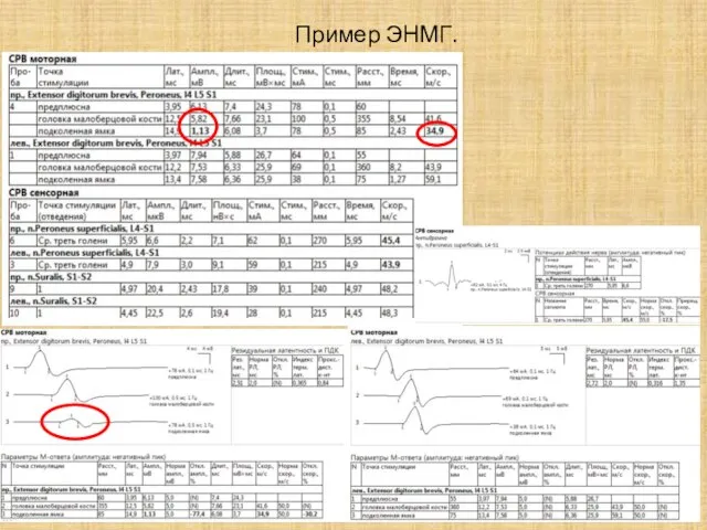 Пример ЭНМГ.