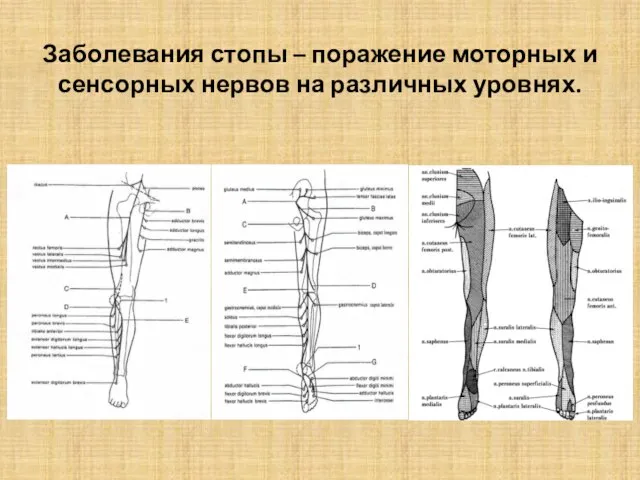 Заболевания стопы – поражение моторных и сенсорных нервов на различных уровнях.