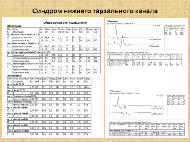 Синдром нижнего тарзального канала